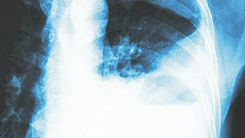 Una nueva aplicación para saber el riesgo de sufrir neumonía