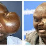 El paciente Mike Koech en dos imágenes, antes y despues, de ser operado por el doctor Pedro Cavadas