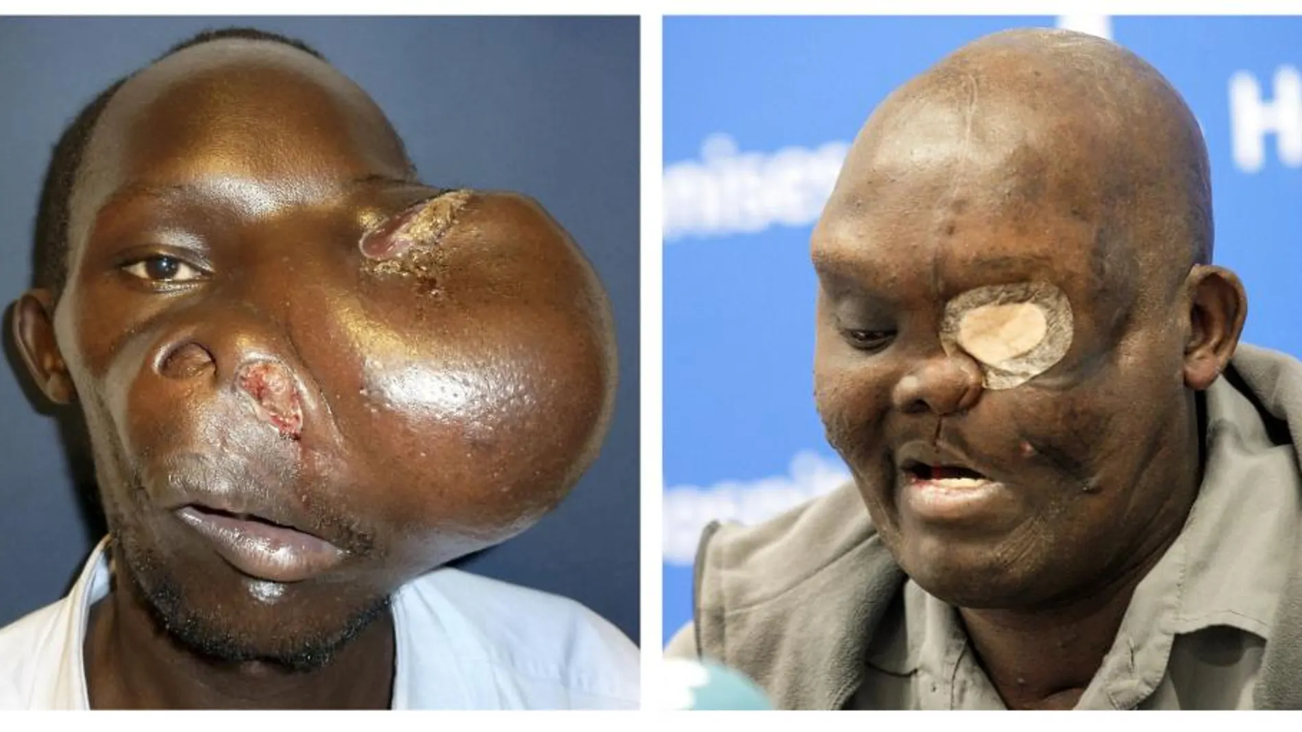 El paciente Mike Koech en dos imágenes, antes y despues, de ser operado por el doctor Pedro Cavadas