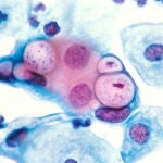 Las infecciones por Clhamydias son las bacterianas más frecuentes en el mundo