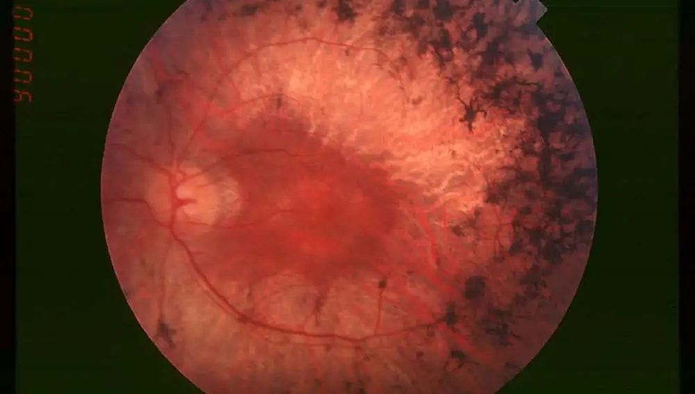Fondo de ojo de un paciente afectado con retinosis pigmentaria. Obsérvese la acumulación de pigmento en la periferia de la retina