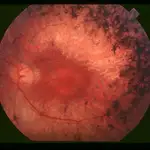 Fondo de ojo de un paciente afectado con retinosis pigmentaria. Obsérvese la acumulación de pigmento en la periferia de la retina