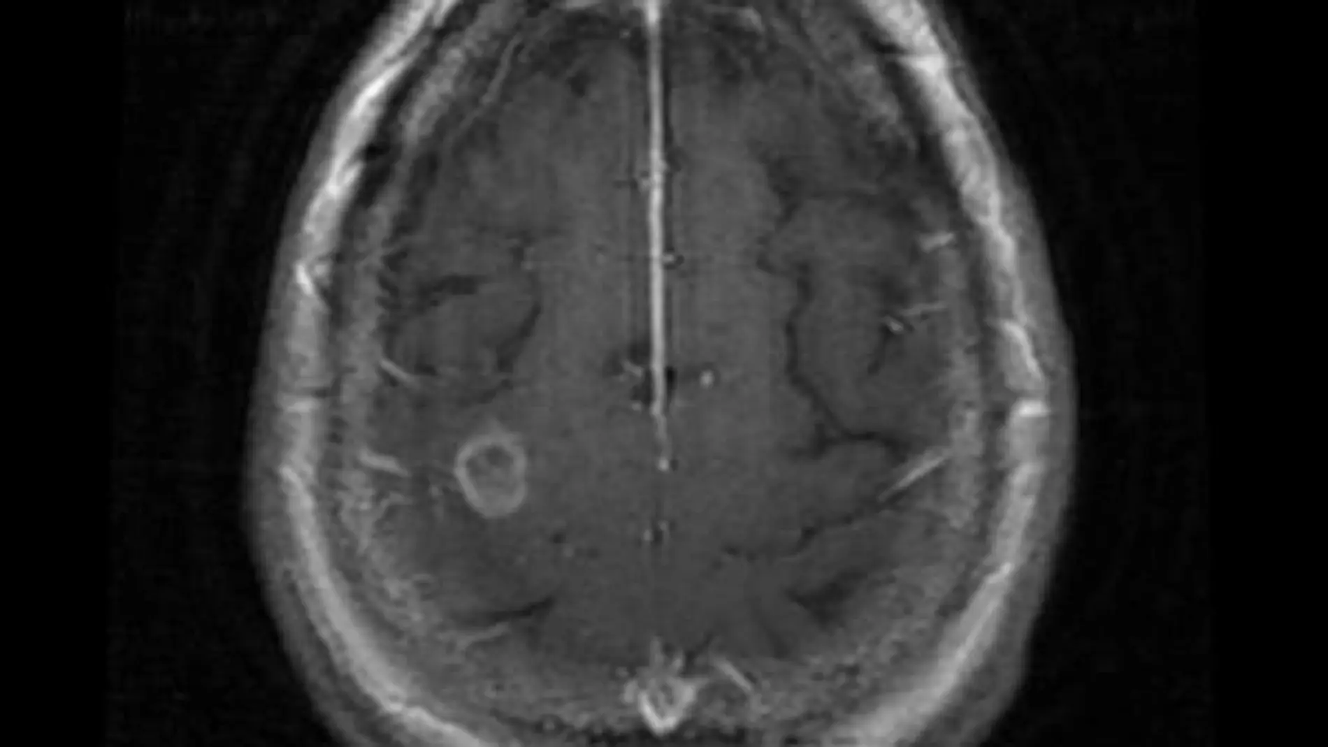 Resonancia magnética de un cerebro afectado por la ameba 'comecerebros'. /Swedish Medical Center