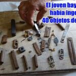 Extraen 32 objetos metálicos del estómago de un cubano