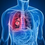 Localizan biomarcadores que permiten diagnóstico precoz de cáncer de pulmón