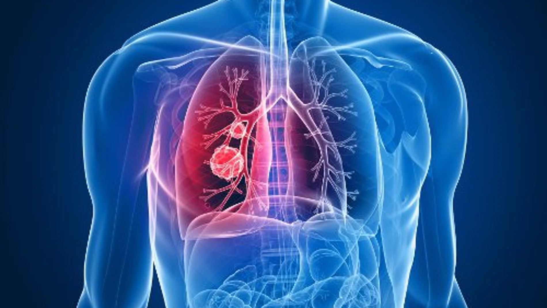 Localizan biomarcadores que permiten diagnóstico precoz de cáncer de pulmón