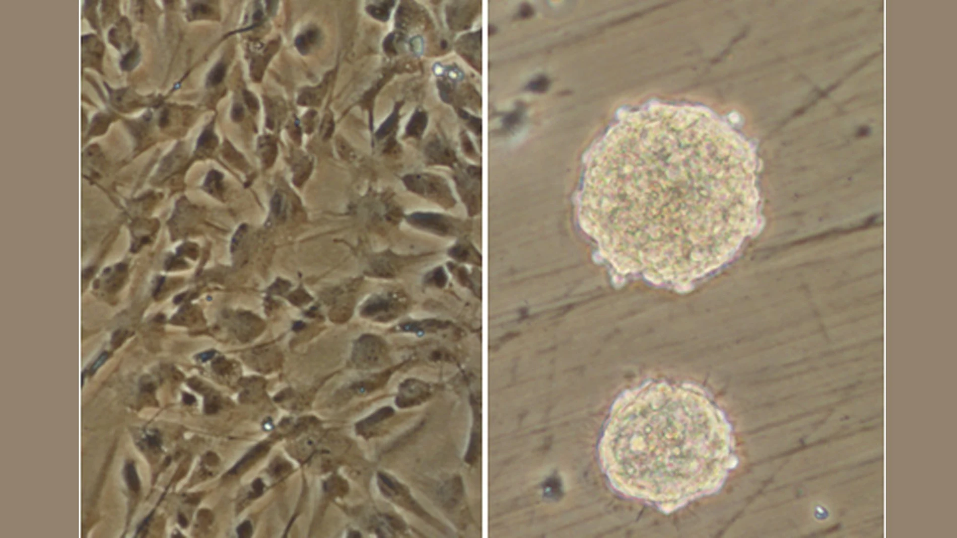 Investigadores del CONICET lograron un importante avance sobre los mecanismos de origen y crecimiento del glioblastoma, una variante de cáncer muy agresiva