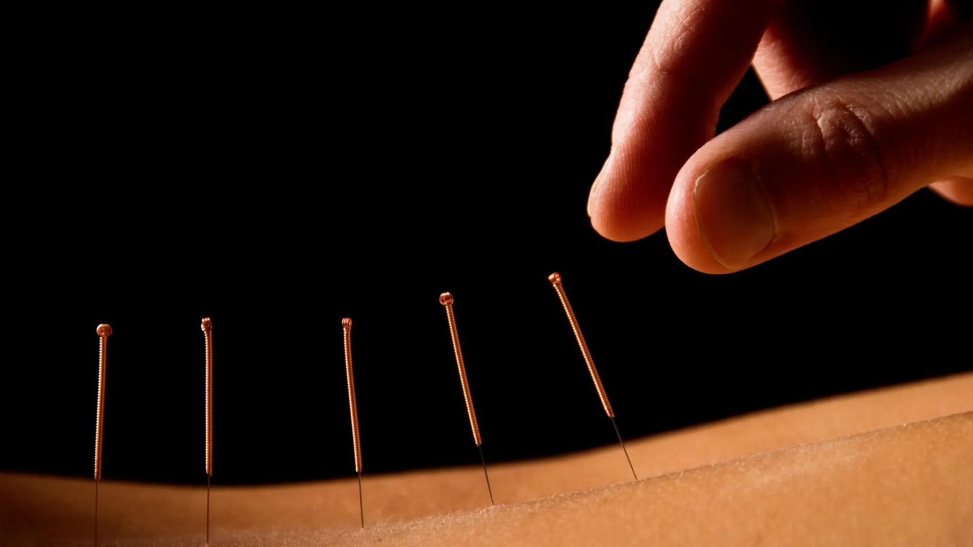 La acupuntura es un método heredado de la medicina tradicional china | Dreamstime