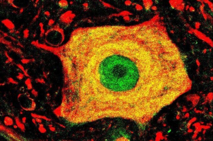 Detalle de una neurona afectada por la Esclerosis Lateral Amiotrófica (ELA)