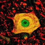 Detalle de una neurona afectada por la Esclerosis Lateral Amiotrófica (ELA)