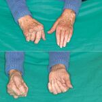 Imágenes en las que se puede apreciar la diferencia entre una mano operada (la de la derecha) y otra que no (la de la izquierda) y en las que se ve que la capacidad de extensión de los dedos es nula en la no operada así como la deformidad