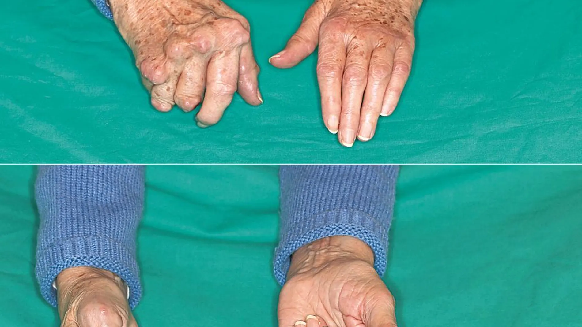 Imágenes en las que se puede apreciar la diferencia entre una mano operada (la de la derecha) y otra que no (la de la izquierda) y en las que se ve que la capacidad de extensión de los dedos es nula en la no operada así como la deformidad