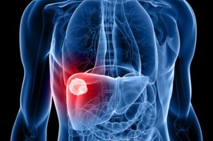 Metástasis del cáncer de hígado