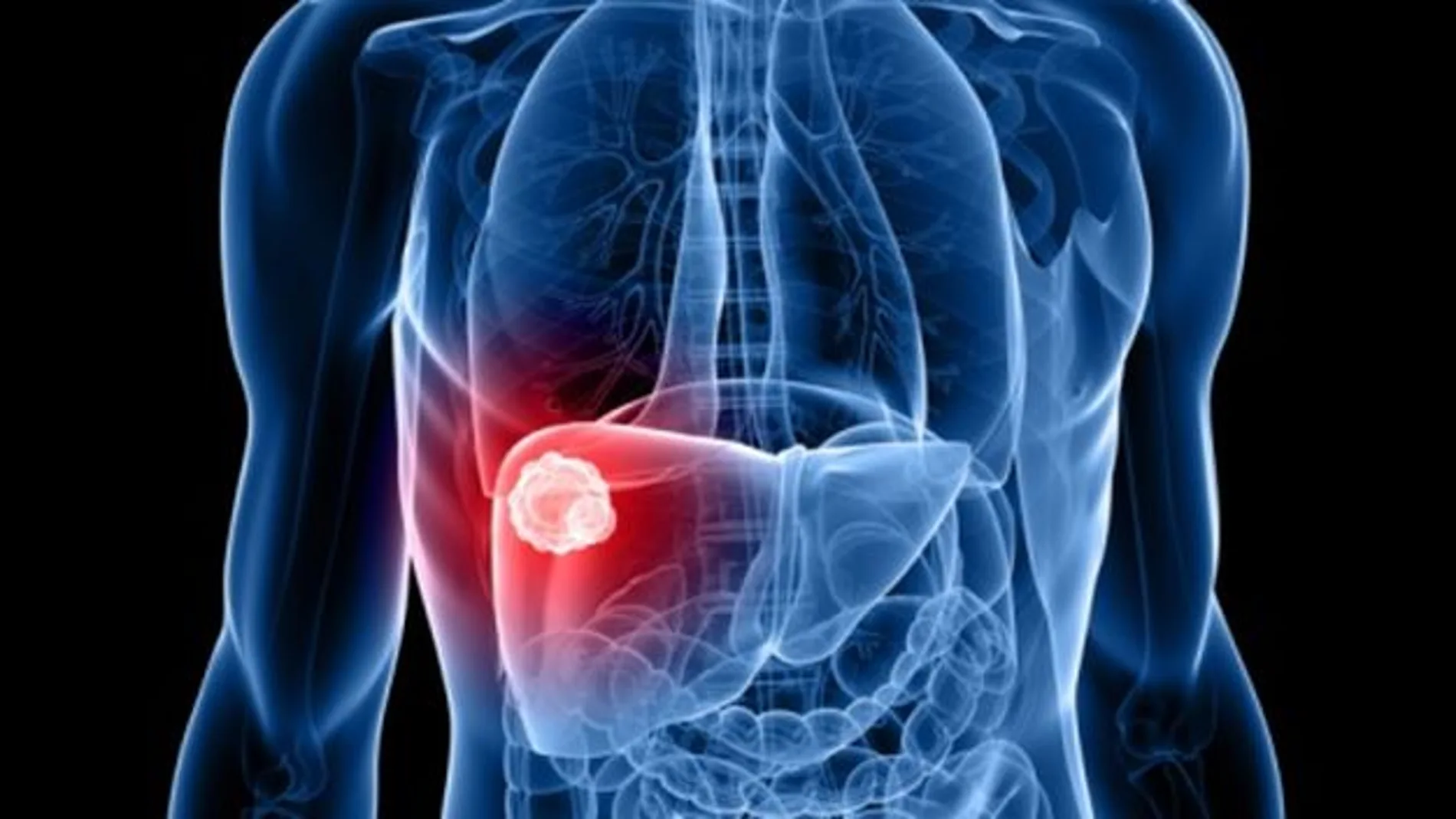 Metástasis del cáncer de hígado