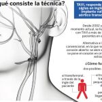 Implante TAVI: reducción de riesgos y pronta recuperación