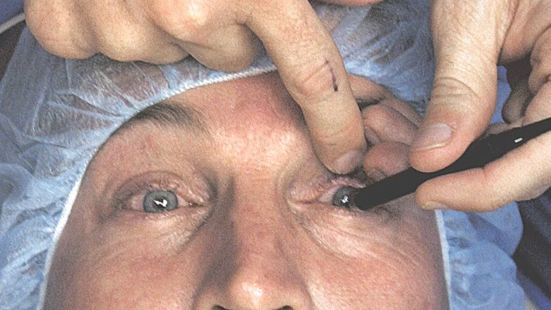 Trasplante parcial de córnea