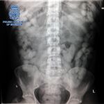 Radiografía de uno de los detenidos