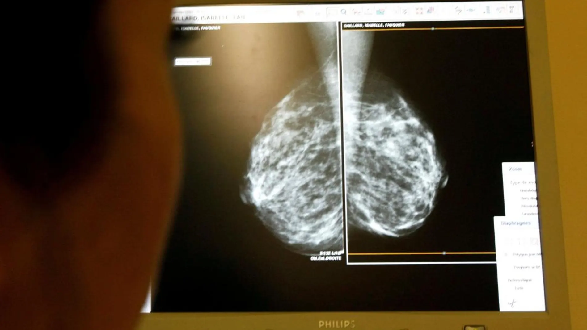 Mamografía/Foto; ReutersF