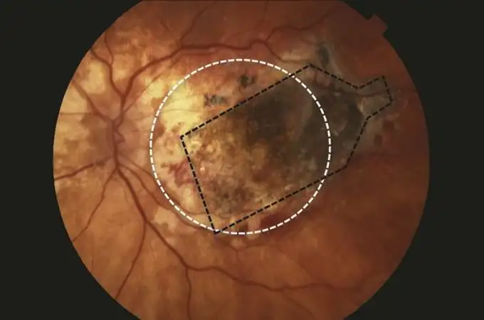 Un implante de retina frena la ceguera