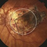 Según los autores, la células madre del implante se integraron con éxito con el tejido y la retina mostró cambios anatómicos consistentes con la reaparición del epitelio pigmentario