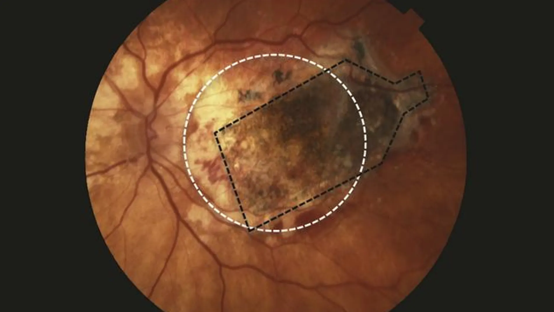 Según los autores, la células madre del implante se integraron con éxito con el tejido y la retina mostró cambios anatómicos consistentes con la reaparición del epitelio pigmentario