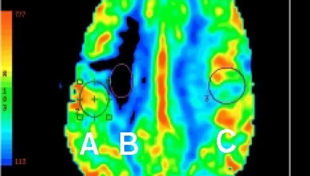 Imagen de archivo de un cerebro a través de una resonancia