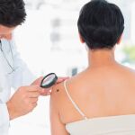 Más de 6.000 casos de melanoma al año en España