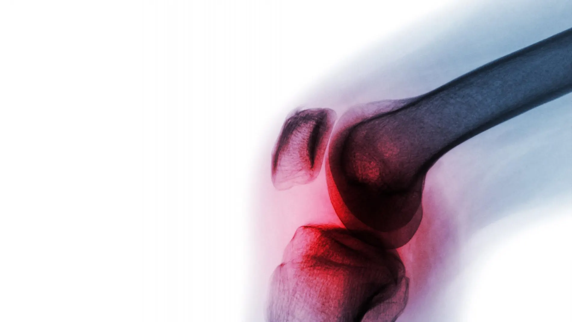 La artritis reumatoide es un trastorno inflamatorio autoinmunitario crónico que afecta al 1% de la población mundial y puede conllevar a graves problemas de salud.