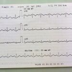 Un electrocardiograma
