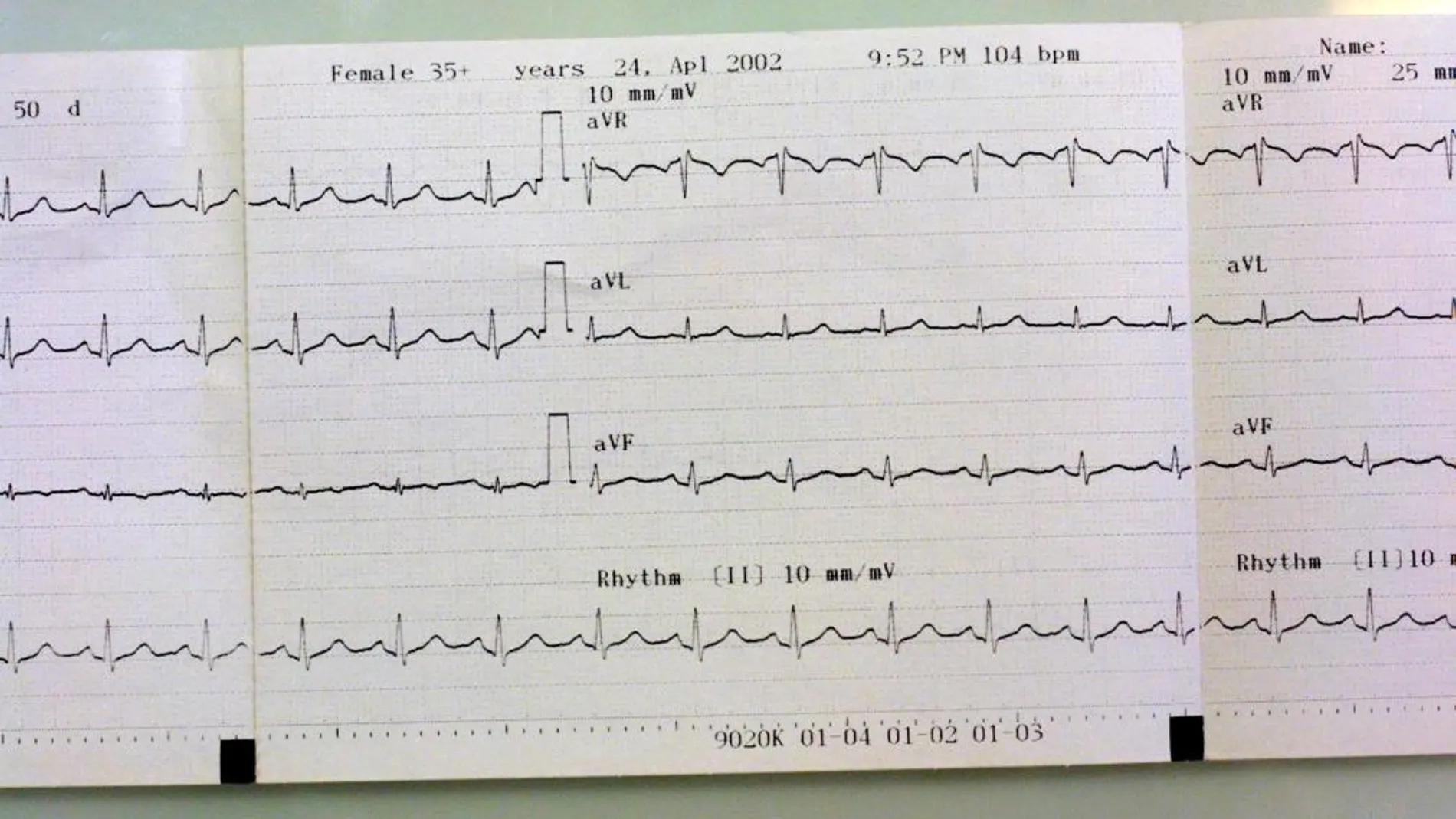 Un electrocardiograma