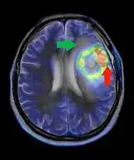 Imagen de un glioblastoma múltiple, el más común y maligno de los tumores cerebrales