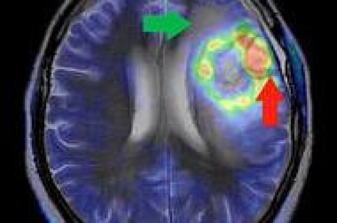 Imagen de un glioblastoma múltiple, el más común y maligno de los tumores cerebrales