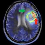 Imagen de un glioblastoma múltiple, el más común y maligno de los tumores cerebrales