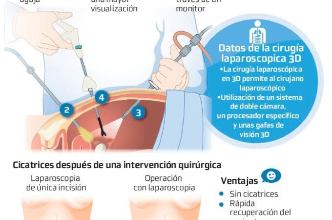 La cirugía laparoscopica 3D permite la utilización de una doble cámara, un procesador específico y unas gafas de visión 3D