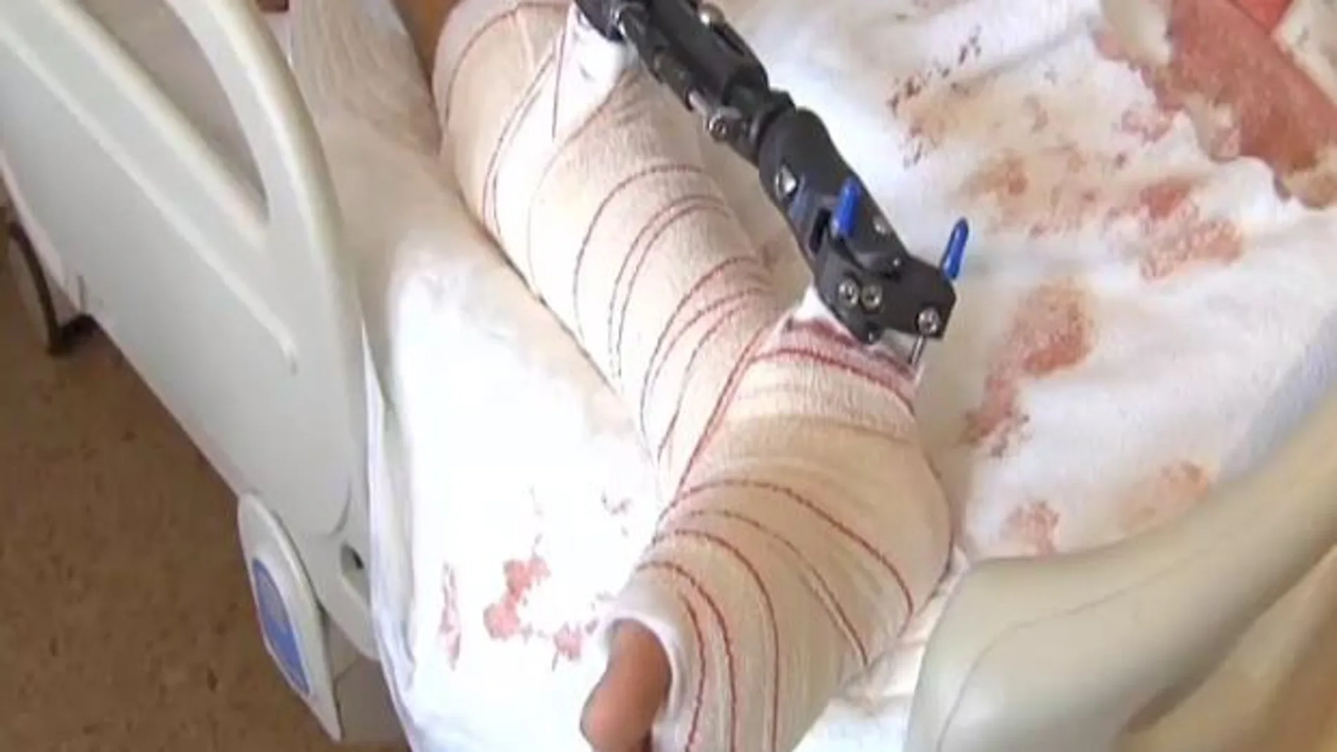 El joven tiene triple fractura de tibia y peroné