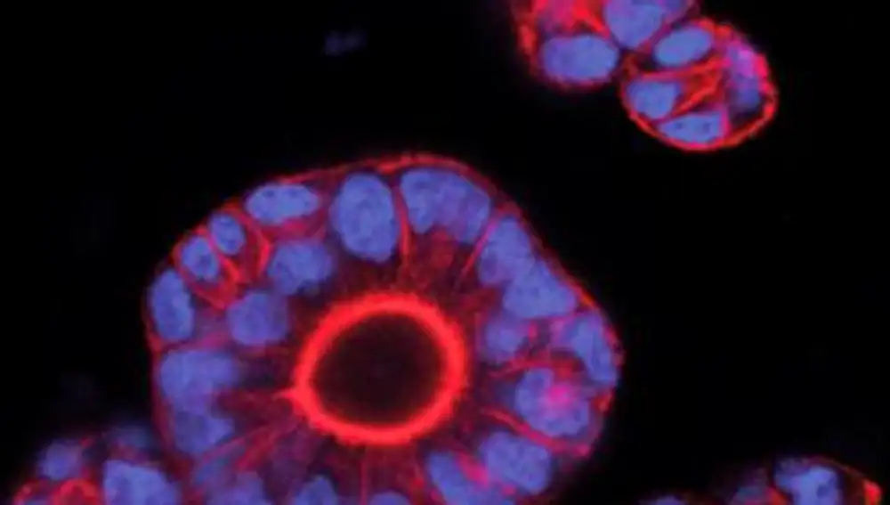 Los tumores se forman a partir de células que se dividen de manera descontrolada. En la imagen, organoides tumorales en crecimiento (cada esfera azul es una célula tumoral independiente.