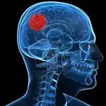 Los gliomas son un tipo de tumor cerebral que se origina en las células gliales del sistema nervioso central (cerebro y médula espinal),