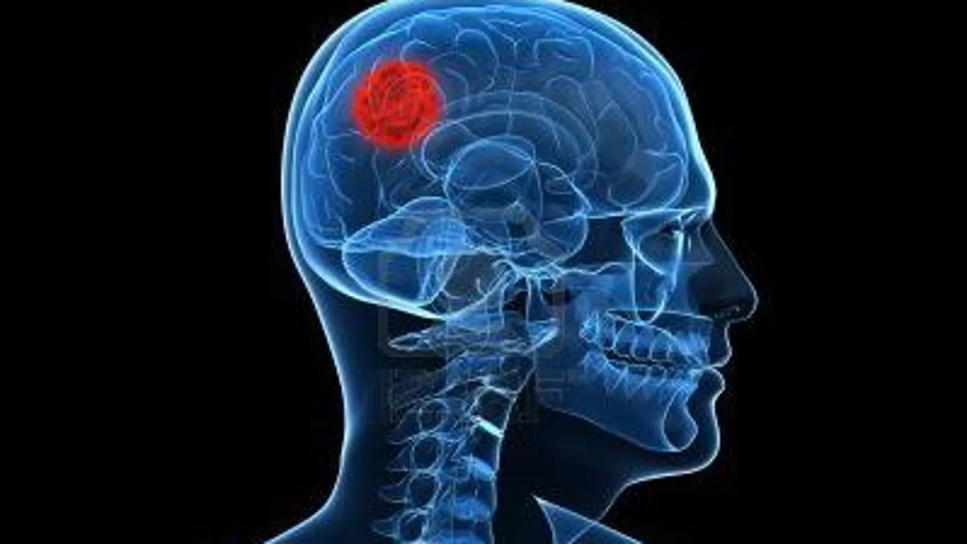 Los gliomas son un tipo de tumor cerebral que se origina en las células gliales del sistema nervioso central (cerebro y médula espinal),