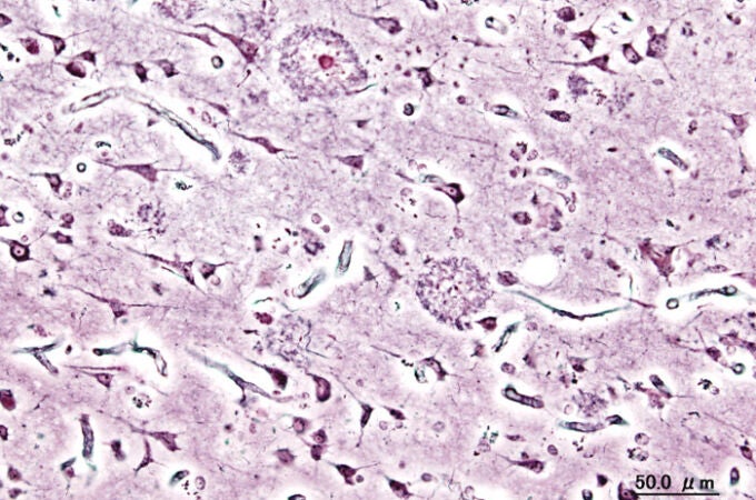 Imagen de las placas seniles (depósitos extracelulares de beta-amiloide en la sustancia gris del cerebro) de un paciente con Alzheimer