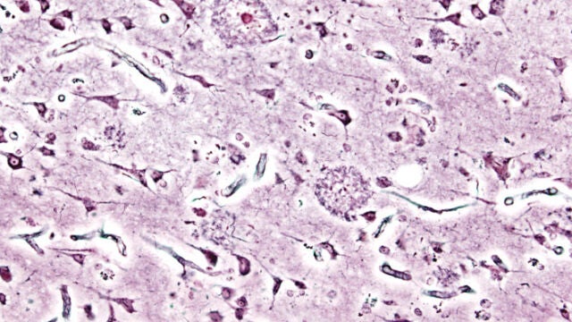 Imagen de las placas seniles (depósitos extracelulares de beta-amiloide en la sustancia gris del cerebro) de un paciente con Alzheimer