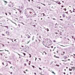 Imagen de las placas seniles (depósitos extracelulares de beta-amiloide en la sustancia gris del cerebro) de un paciente con Alzheimer