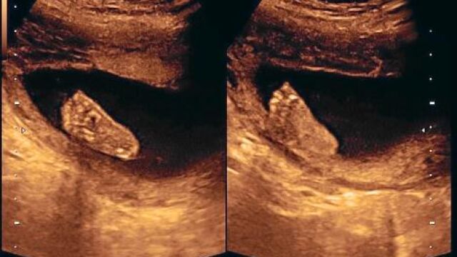El Comité de Bioética respalda la reforma del aborto de Gallardón