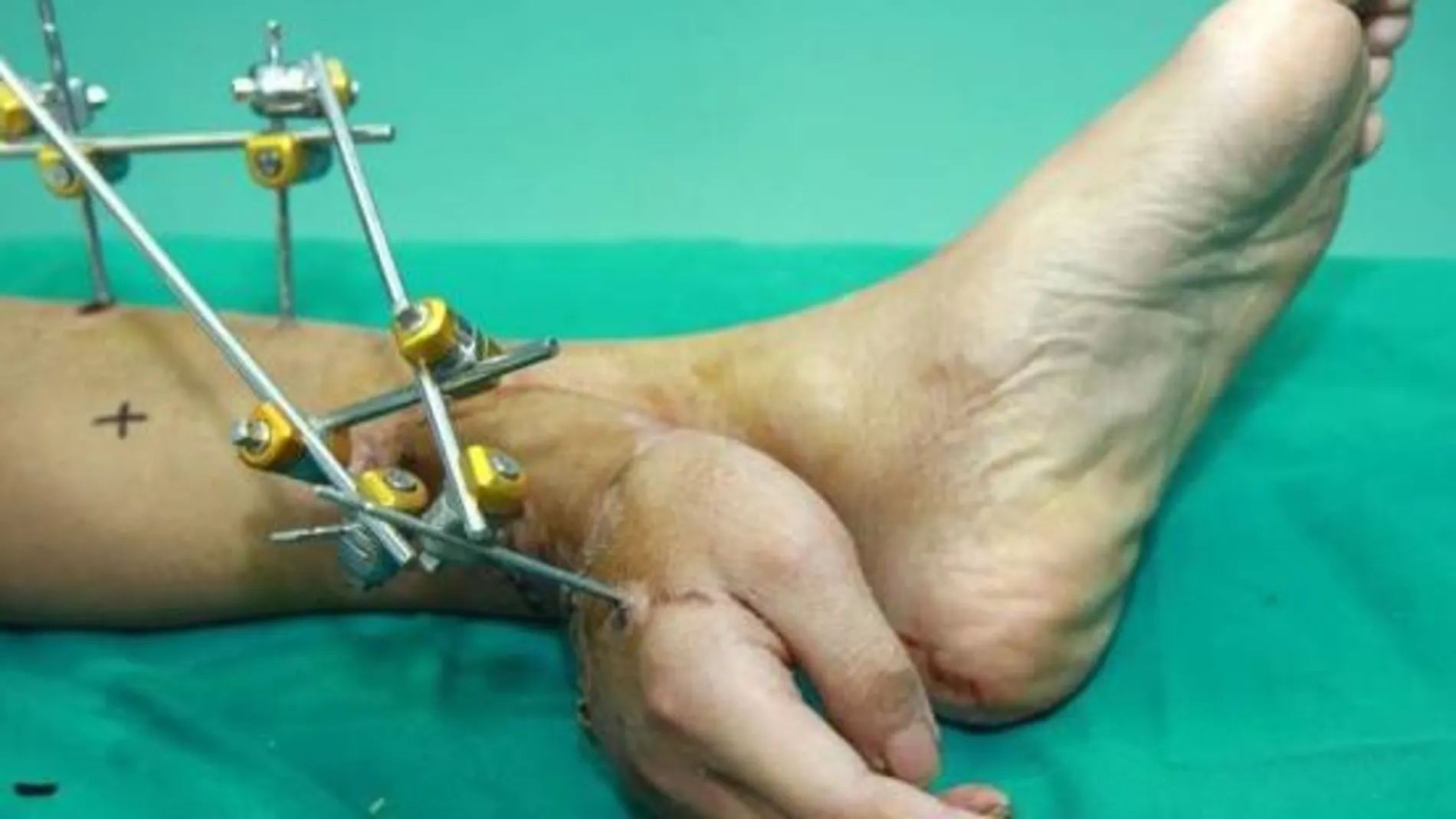 Imagen de la mano unida al tobillo del paciente