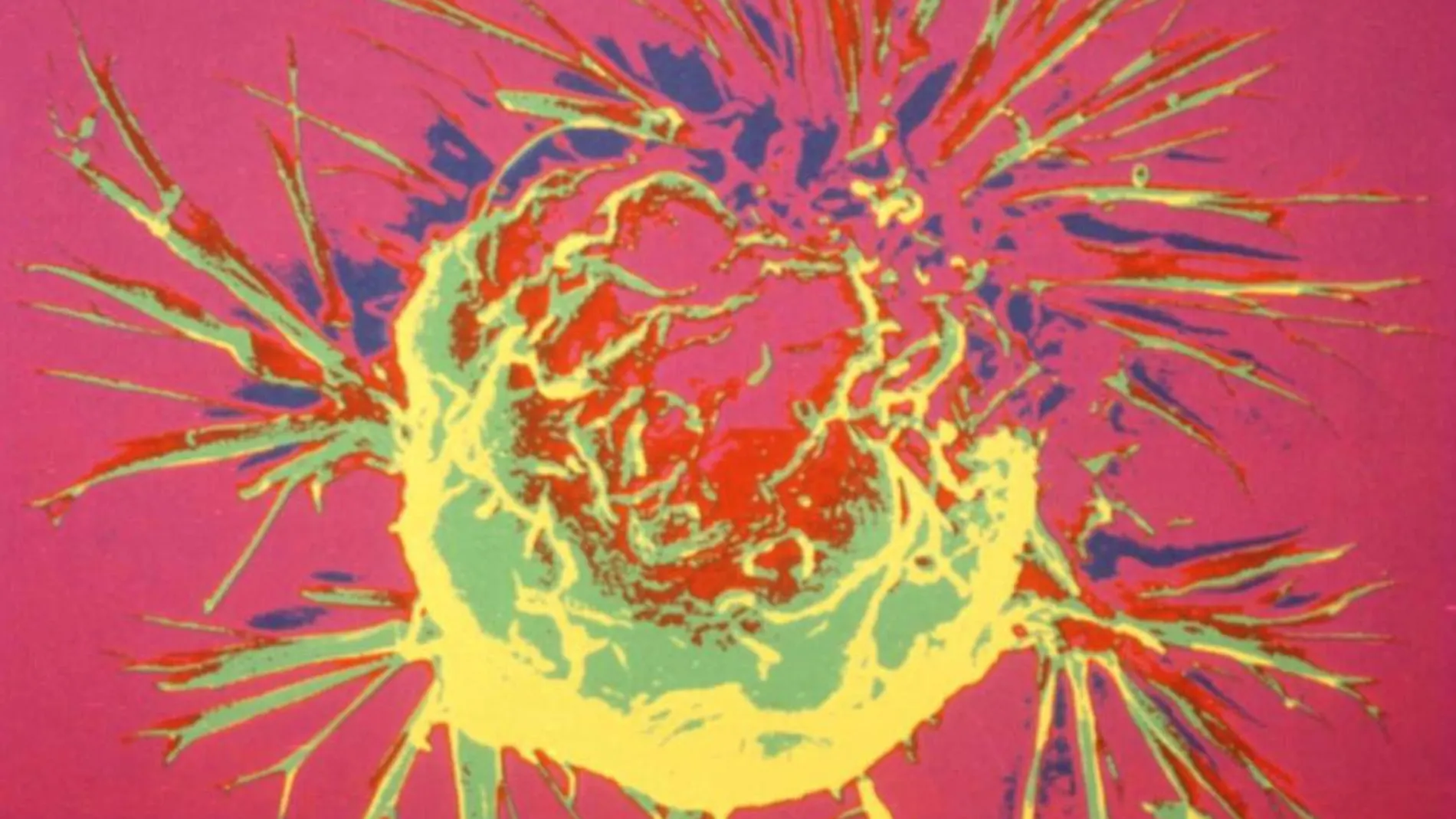 Imagen microscopica de cáncer de mama a nivel celular