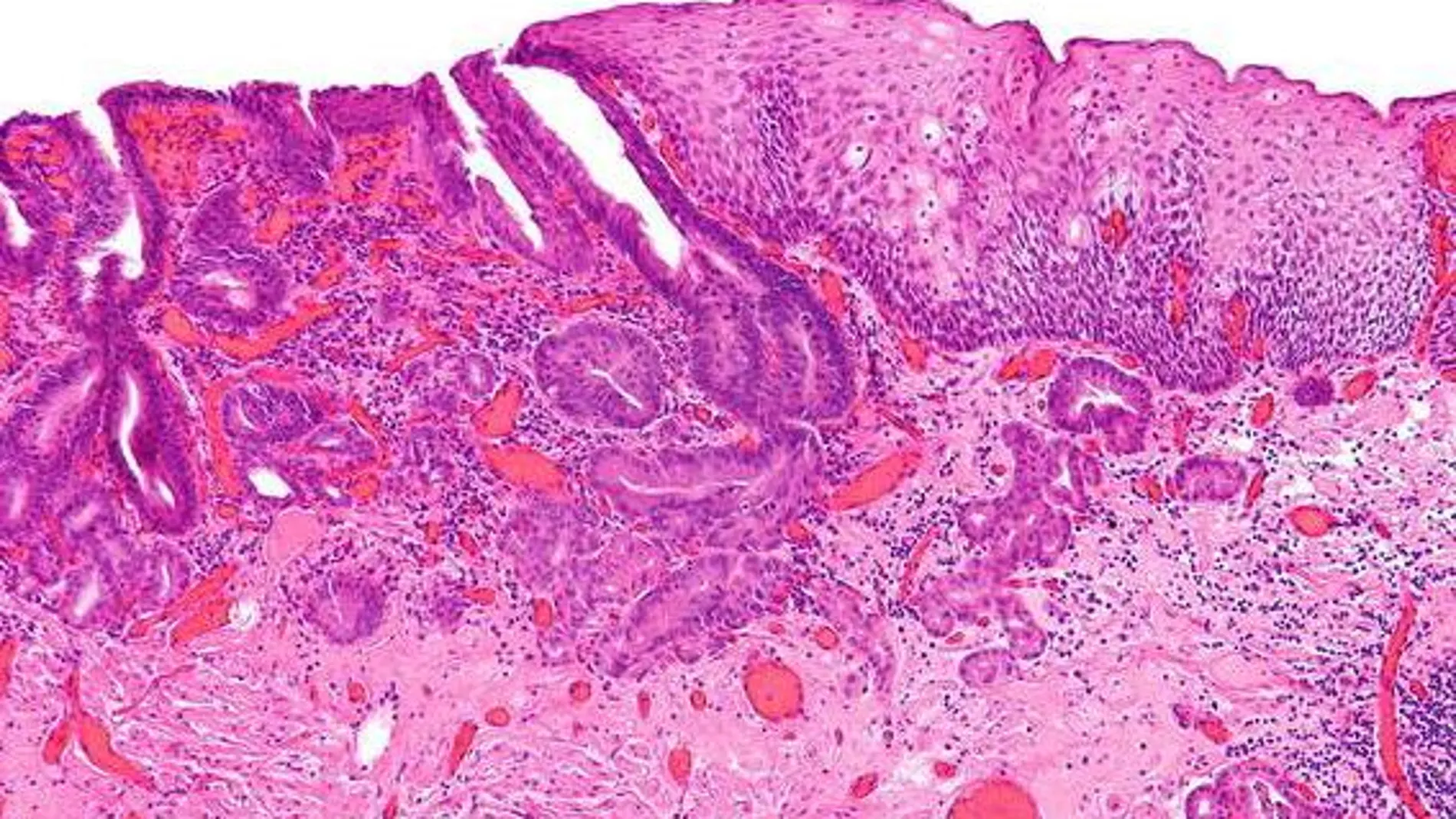 Microcarcinoma de esófago