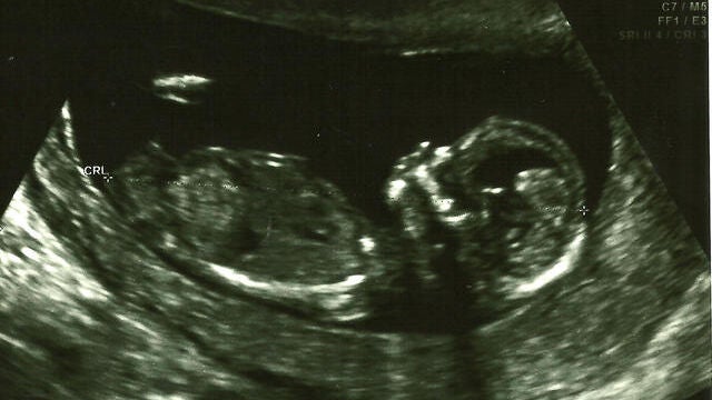 Ecografía del test de cribado realizada en la semana 13