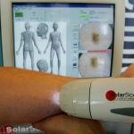 Tratamiento para prevenir melanomas