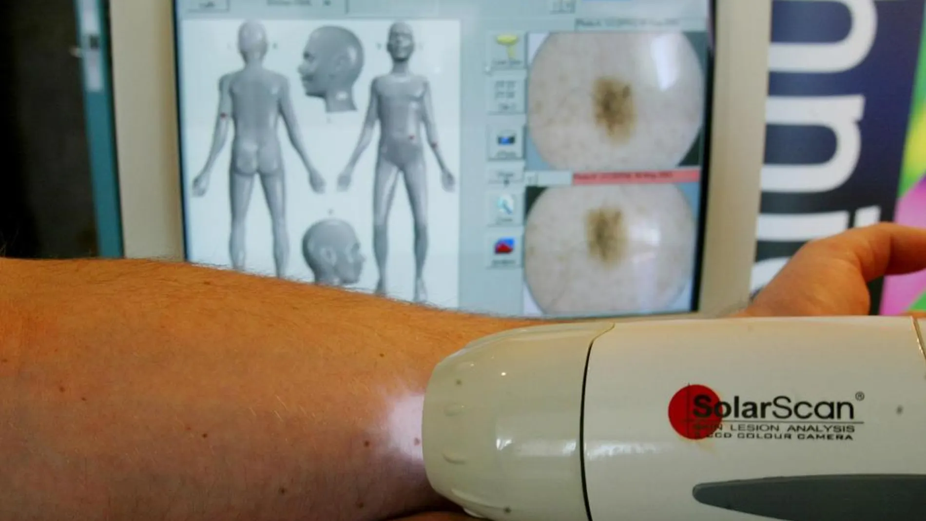 Tratamiento para prevenir melanomas