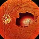 Imagen de un ojo con degeneración macular