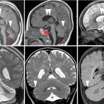 La extraña malformación neuronal heredada del Imperio otomano